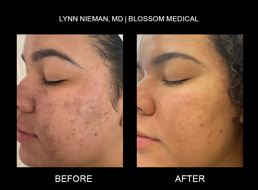 Before and after photo of face